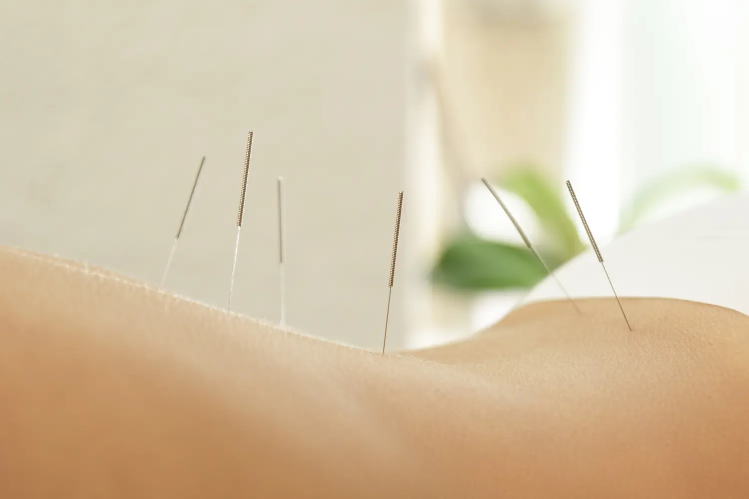 Frauenrücken mit Stahlnadeln während der Akupunkturtherapie